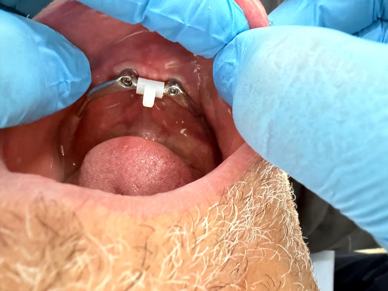 Caso de prótese sobre barra de implantes atendido pelo Dr. Cleber Prudêncio — antes